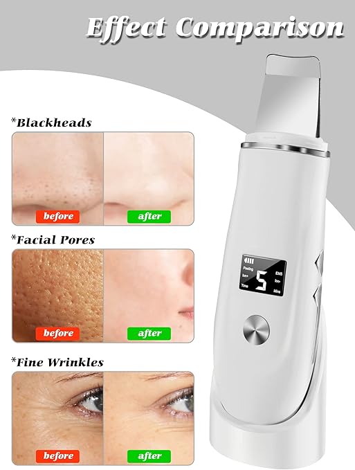 Skin Scrubber, Blackhead Remover Tool with Rechargeable Base, LCD Display, Ultrasonic Skin Scraper Pore Cleanser Skin Care Tools for Facial Deep Cleansing - 4 Modes
